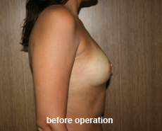 plastic-surgery-breast-augmentation